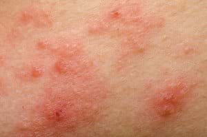 atopic dermatitis pictures hagyományos kezelések a pikkelysömörhöz